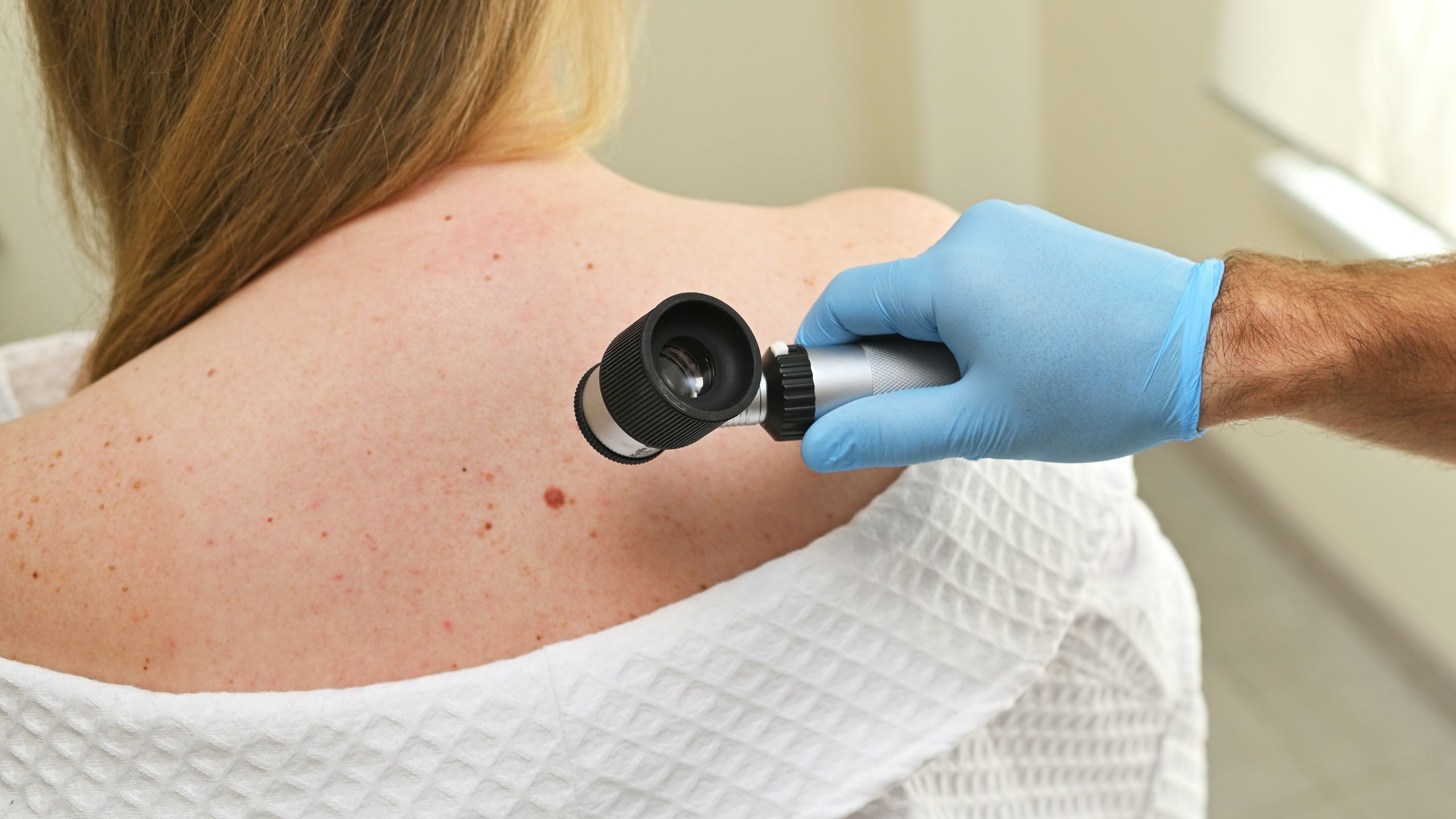 Examine the mole using the ABCDEF method: This is how you recognize skin cancer early